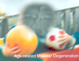 Age related Macular Degeneration