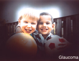 Glaucoma
